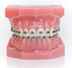 Self-Ligating Damon Braces