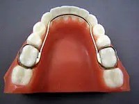 Lower Lingual Holding Arch (LLHA)