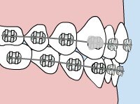 Self-Ligating Damon Braces