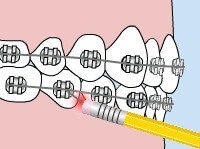 Self-Ligating Damon Braces