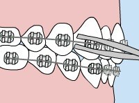 Self-Ligating Damon Braces